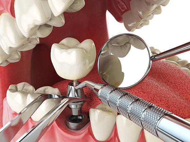 Best Emergency Tooth Extraction in Cooperstown, NY